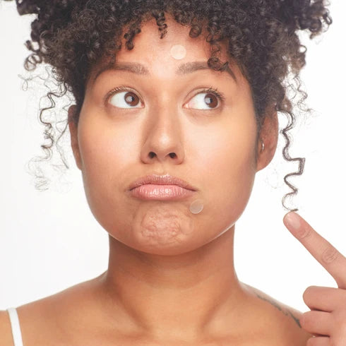 Patchology Breakout Box: 3-in-1 Acne Treatment Kit